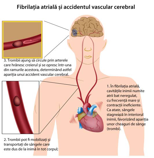 fibrilatie-atriala